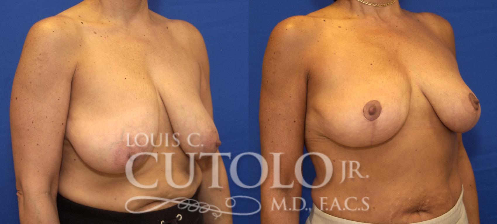 Before & After Breast Reduction Case 82 View #4 View in Brooklyn, Staten Island, Queens, NY