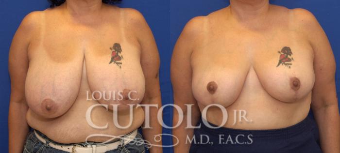 Before & After Breast Reduction Case 93 View #1 View in Brooklyn, Staten Island, Queens, NY