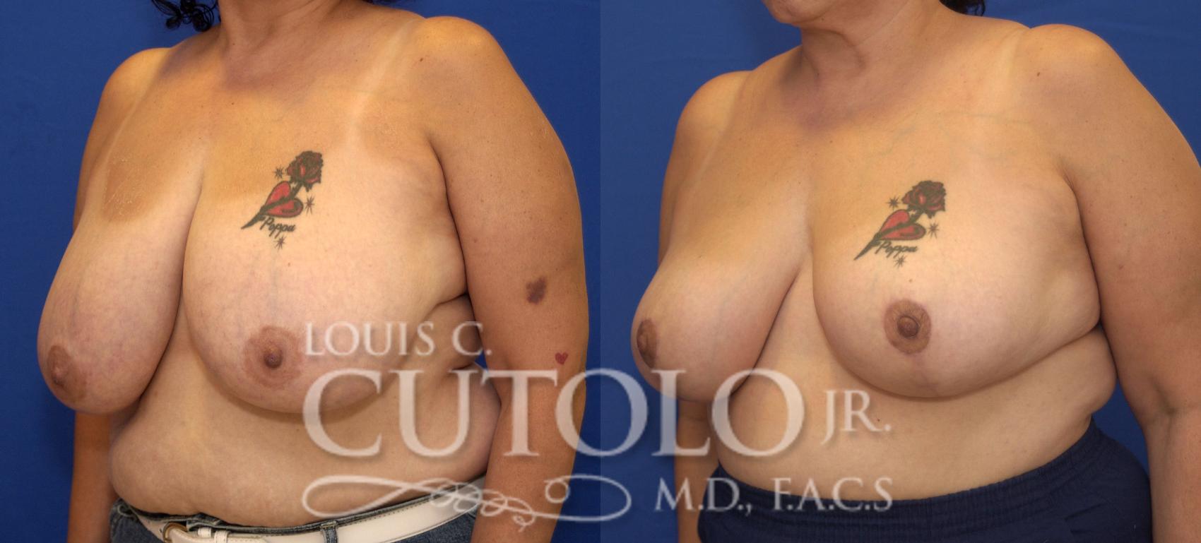 Before & After Breast Reduction Case 93 View #2 View in Brooklyn, Staten Island, Queens, NY