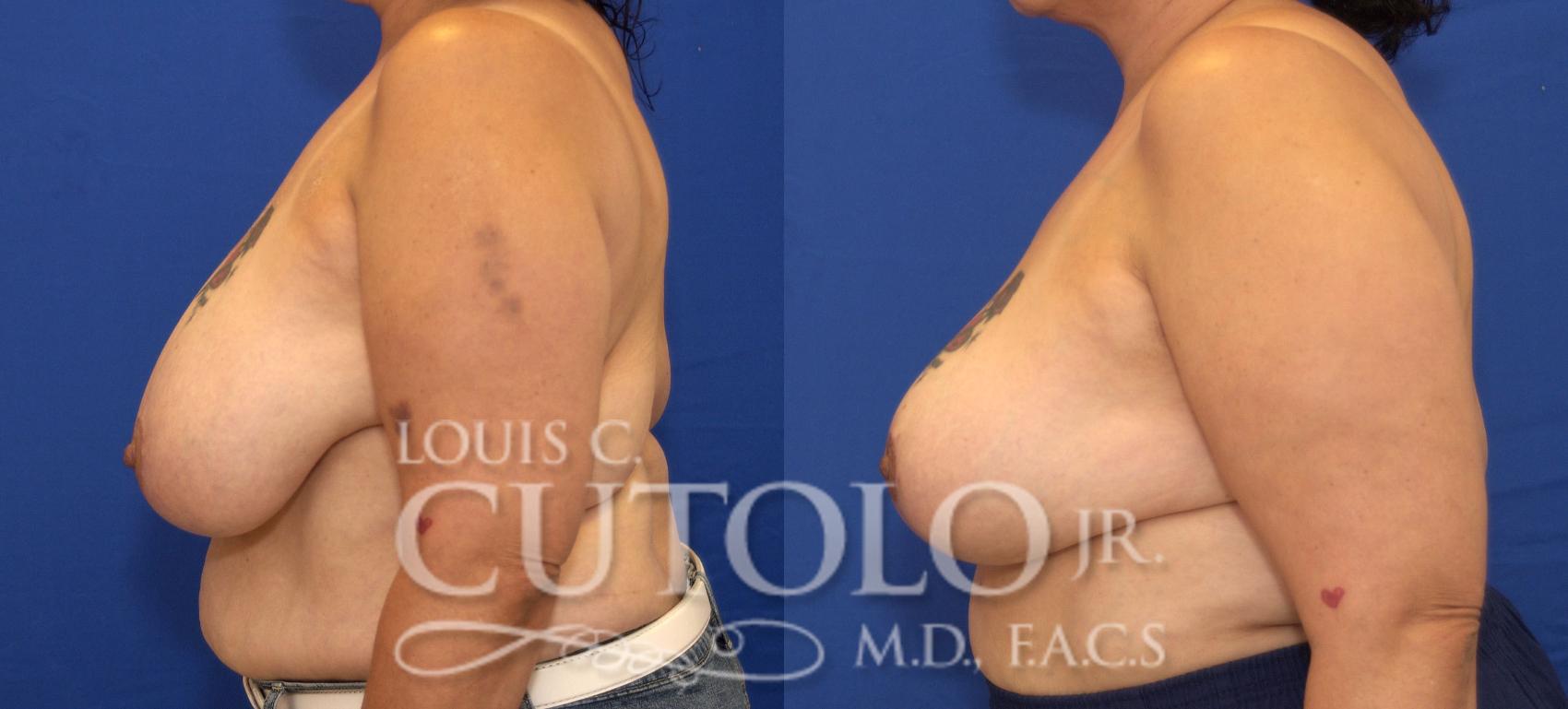 Before & After Breast Reduction Case 93 View #3 View in Brooklyn, Staten Island, Queens, NY