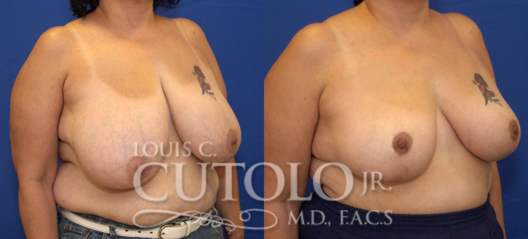 Before & After Breast Reduction Case 93 View #4 View in Brooklyn, Staten Island, Queens, NY