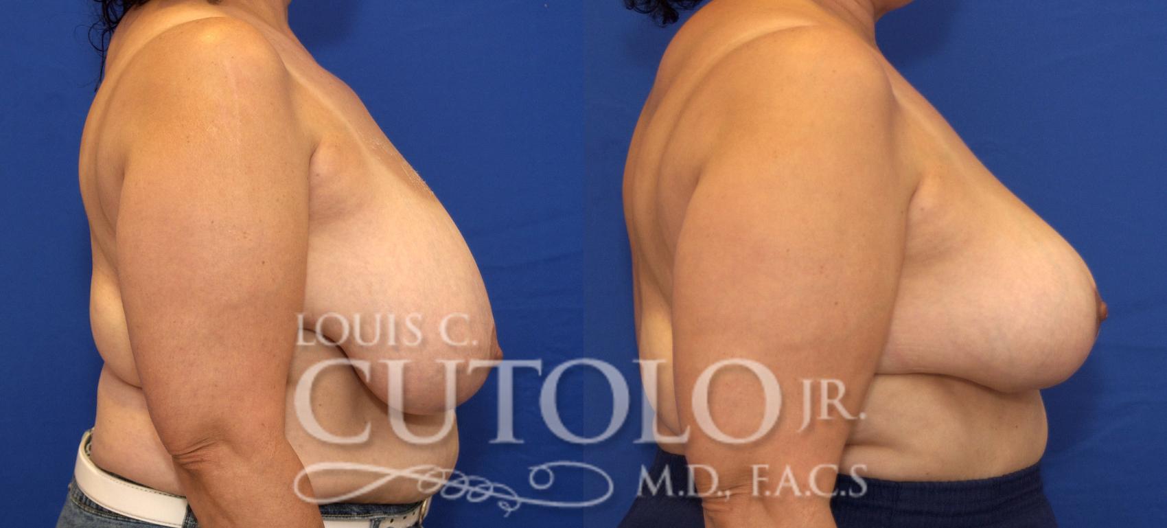 Before & After Breast Reduction Case 93 View #5 View in Brooklyn, Staten Island, Queens, NY