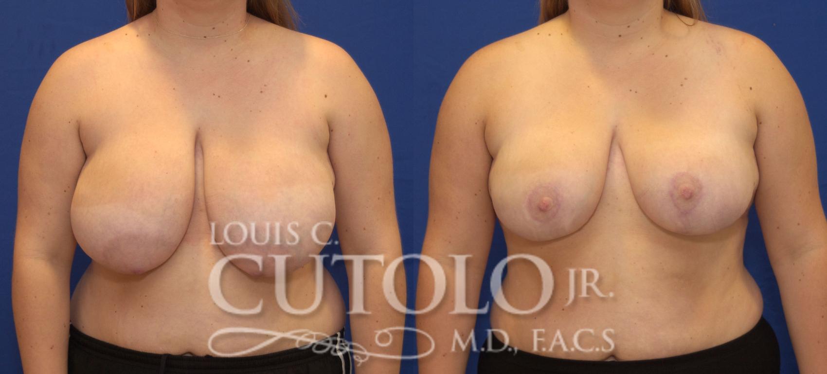 Before & After Breast Reduction Case 94 View #1 View in Brooklyn, Staten Island, Queens, NY