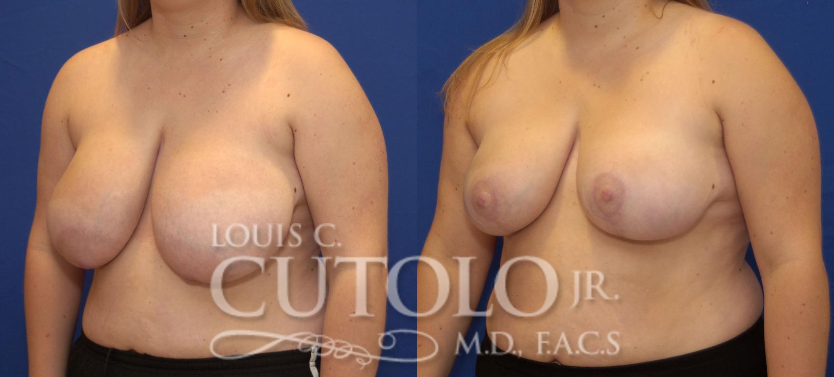 Before & After Breast Reduction Case 94 View #2 View in Brooklyn, Staten Island, Queens, NY