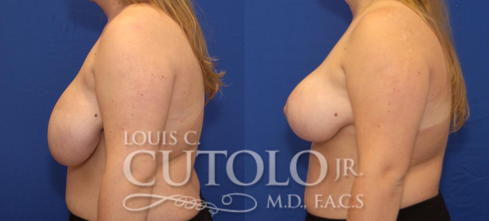 Before & After Breast Reduction Case 94 View #3 View in Brooklyn, Staten Island, Queens, NY