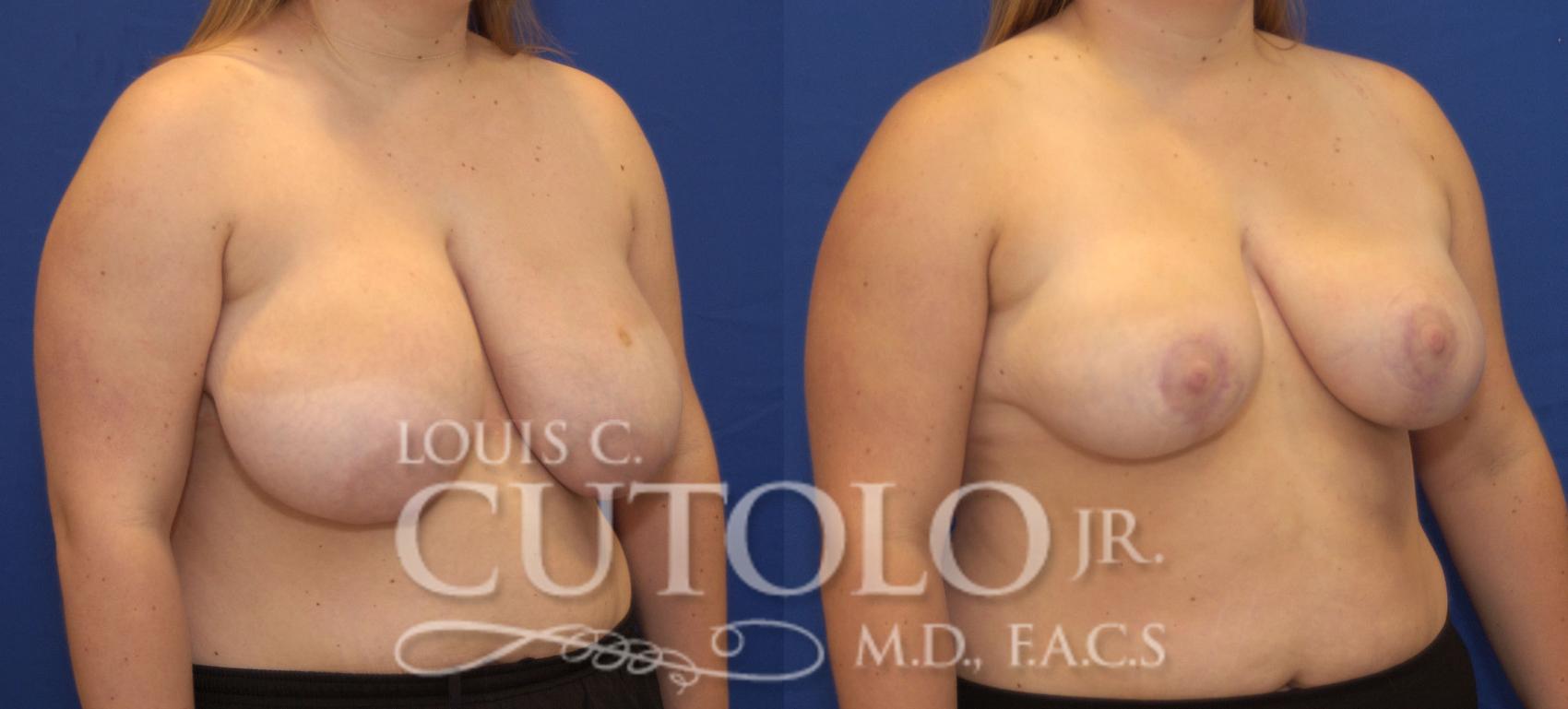 Before & After Breast Reduction Case 94 View #4 View in Brooklyn, Staten Island, Queens, NY
