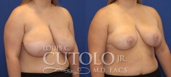 Before & After Breast Reduction Case 94 View #4 View in Brooklyn, Staten Island, Queens, NY