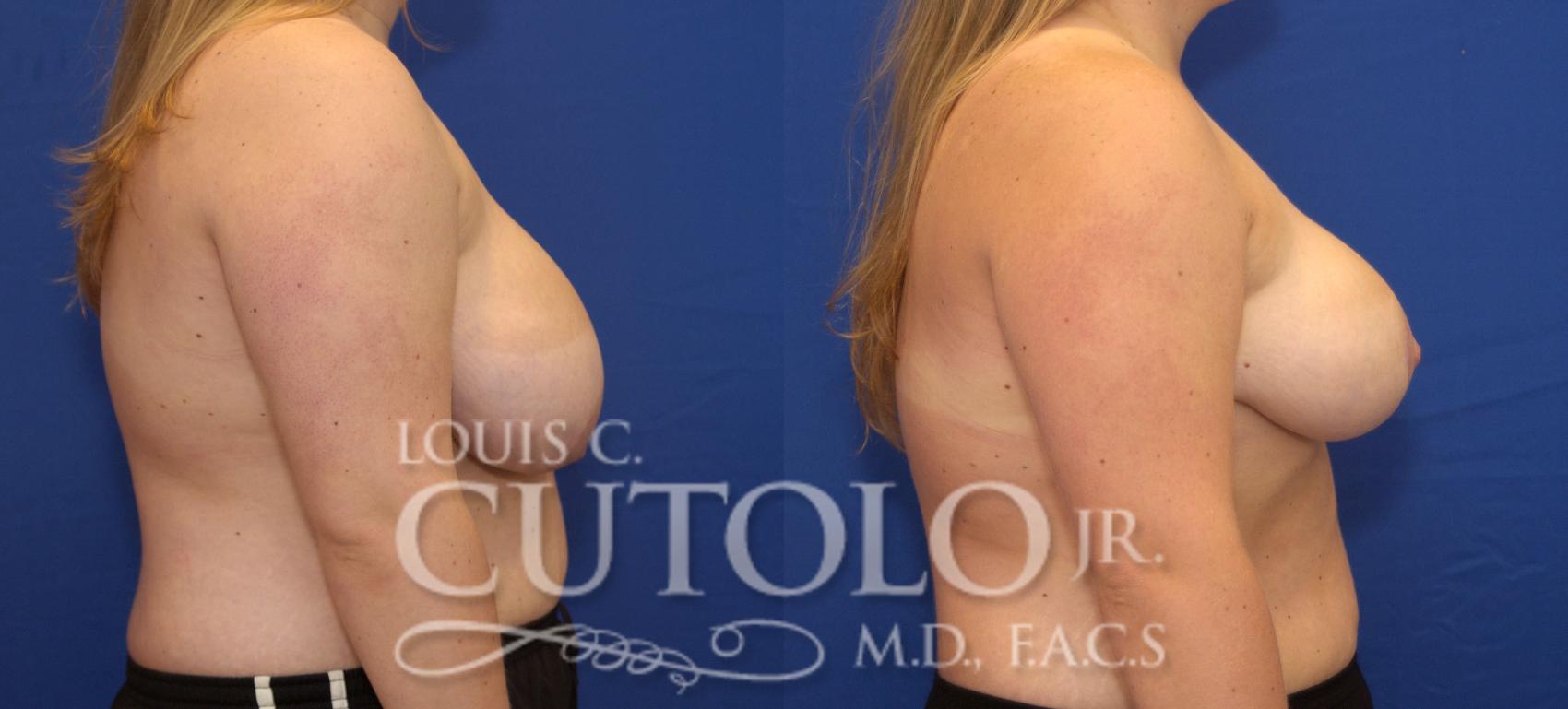 Before & After Breast Reduction Case 94 View #5 View in Brooklyn, Staten Island, Queens, NY