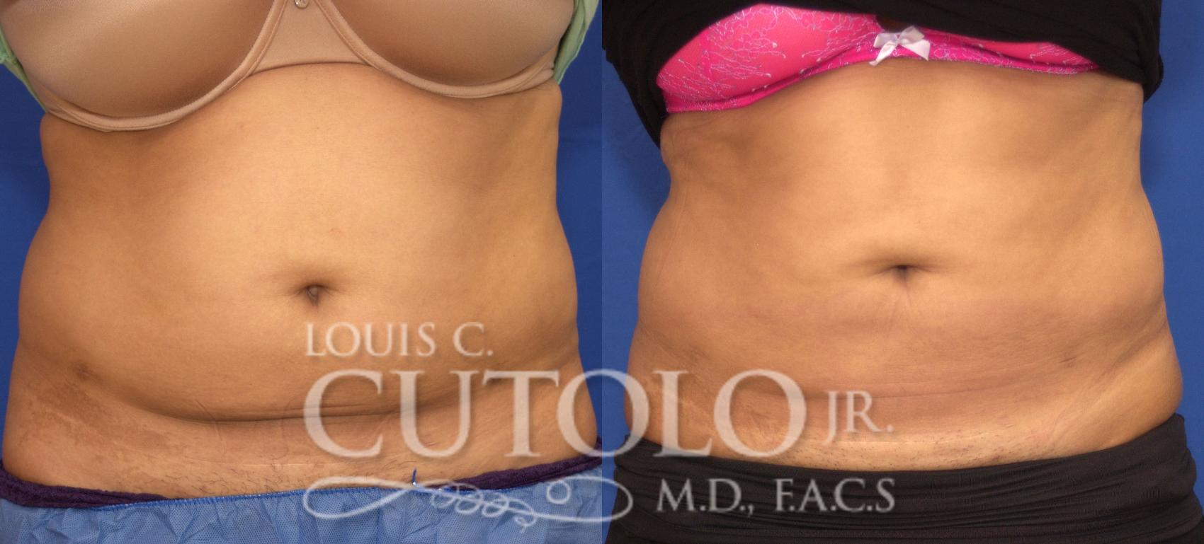 Before & After CoolSculpting® Case 125 View #1 View in Brooklyn, Staten Island, Queens, NY
