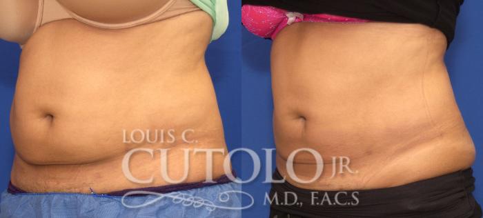 Before & After CoolSculpting® Case 125 View #2 View in Brooklyn, Staten Island, Queens, NY