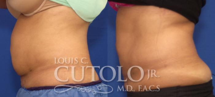Before & After CoolSculpting® Case 125 View #3 View in Brooklyn, Staten Island, Queens, NY