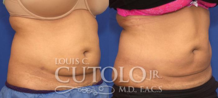 Before & After CoolSculpting® Case 125 View #4 View in Brooklyn, Staten Island, Queens, NY