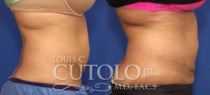 Before & After CoolSculpting® Case 125 View #5 View in Brooklyn, Staten Island, Queens, NY