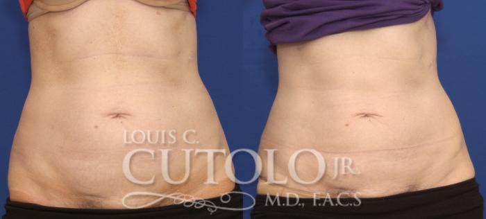 Before & After CoolSculpting® Case 138 View #1 View in Brooklyn, Staten Island, Queens, NY