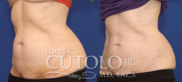 Before & After CoolSculpting® Case 138 View #2 View in Brooklyn, Staten Island, Queens, NY