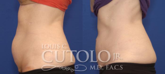 Before & After CoolSculpting® Case 138 View #3 View in Brooklyn, Staten Island, Queens, NY