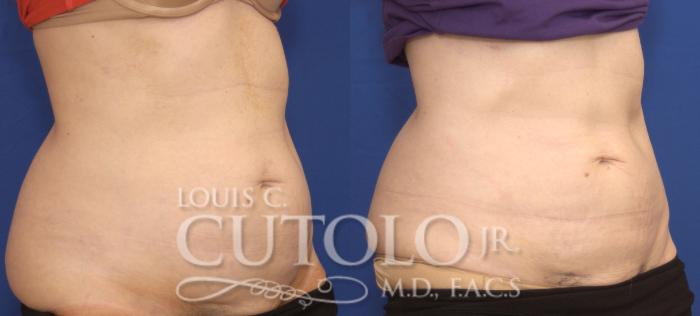 Before & After CoolSculpting® Case 138 View #4 View in Brooklyn, Staten Island, Queens, NY