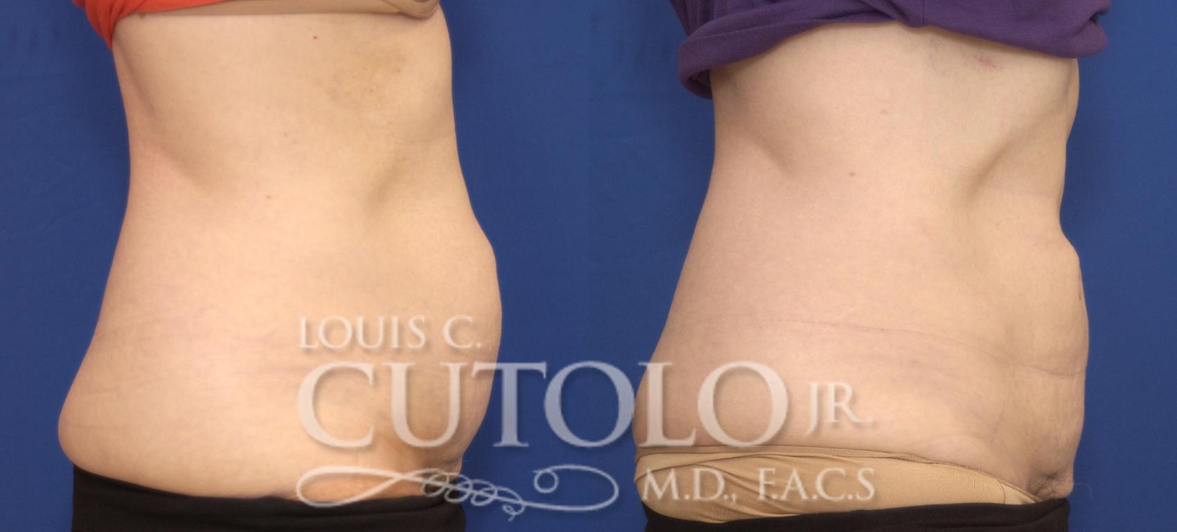 Before & After CoolSculpting® Case 138 View #5 View in Brooklyn, Staten Island, Queens, NY