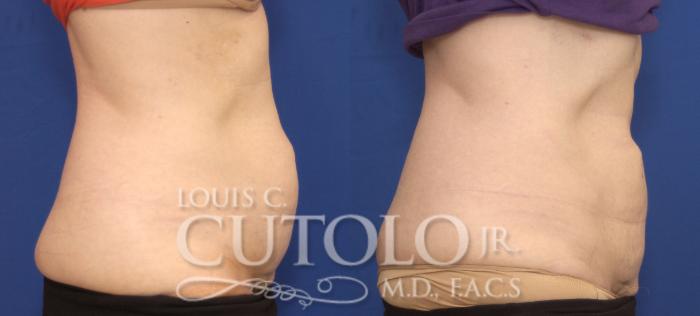 Before & After CoolSculpting® Case 138 View #5 View in Brooklyn, Staten Island, Queens, NY