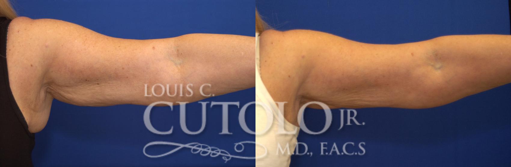 Before & After CoolSculpting® Case 139 View #1 View in Brooklyn, Staten Island, Queens, NY