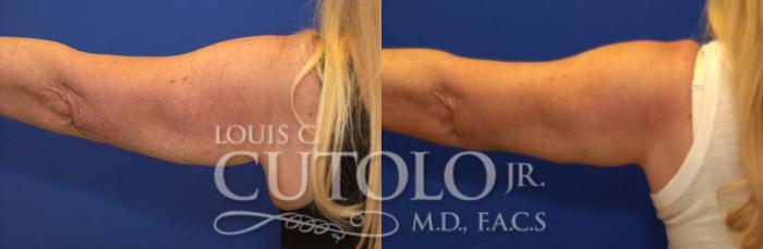 Before & After CoolSculpting® Case 139 View #2 View in Brooklyn, Staten Island, Queens, NY