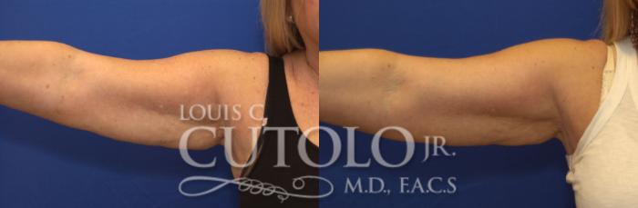 Before & After CoolSculpting® Case 139 View #3 View in Brooklyn, Staten Island, Queens, NY