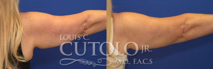 Before & After CoolSculpting® Case 139 View #4 View in Brooklyn, Staten Island, Queens, NY