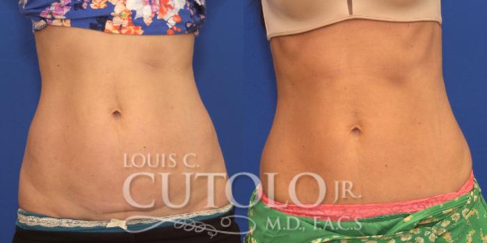 Before & After CoolSculpting® Case 148 View #1 View in Brooklyn, Staten Island, Queens, NY