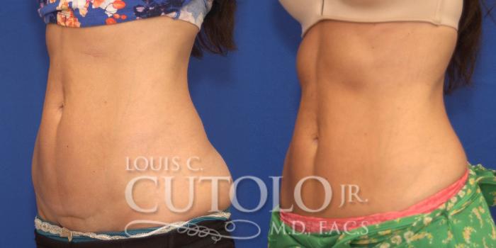 Before & After CoolSculpting® Case 148 View #2 View in Brooklyn, Staten Island, Queens, NY
