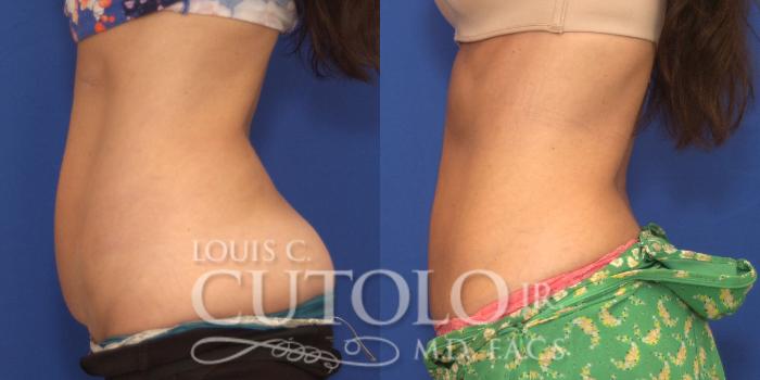Before & After CoolSculpting® Case 148 View #3 View in Brooklyn, Staten Island, Queens, NY