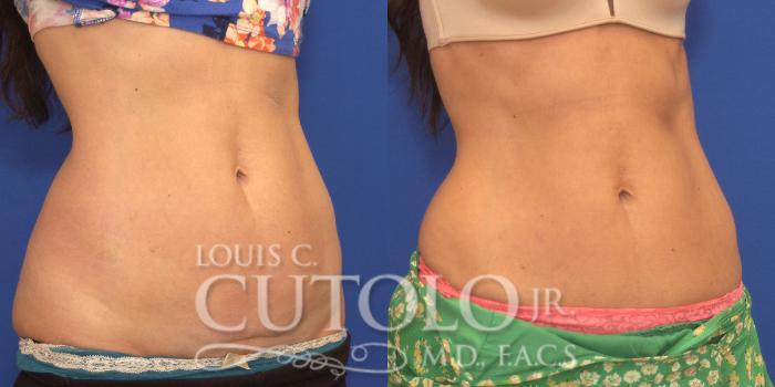 Before & After CoolSculpting® Case 148 View #4 View in Brooklyn, Staten Island, Queens, NY