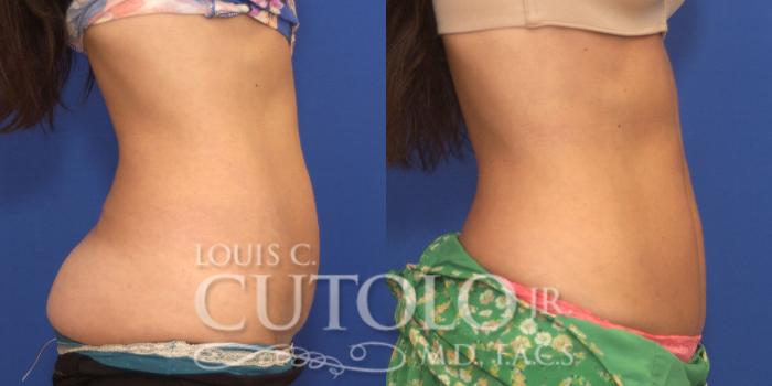 Before & After CoolSculpting® Case 148 View #5 View in Brooklyn, Staten Island, Queens, NY