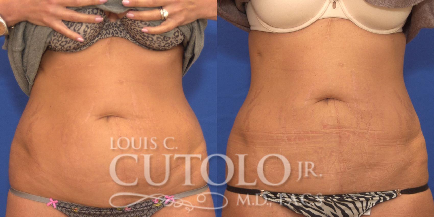 Before & After CoolSculpting® Case 153 View #1 View in Brooklyn, Staten Island, Queens, NY