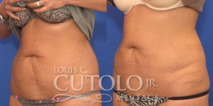 Before & After CoolSculpting® Case 153 View #2 View in Brooklyn, Staten Island, Queens, NY