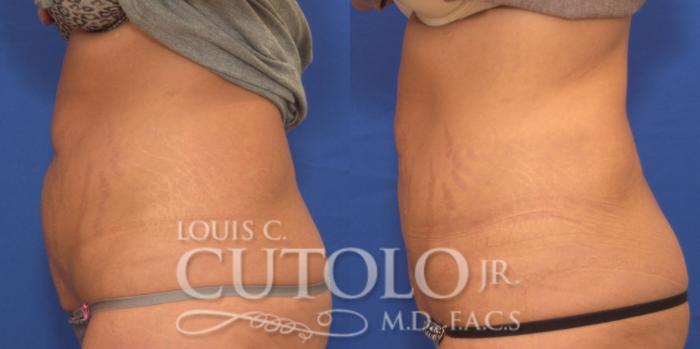 Before & After CoolSculpting® Case 153 View #3 View in Brooklyn, Staten Island, Queens, NY