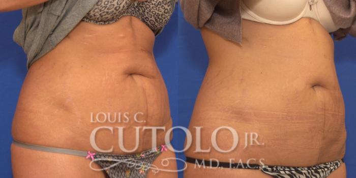 Before & After CoolSculpting® Case 153 View #4 View in Brooklyn, Staten Island, Queens, NY