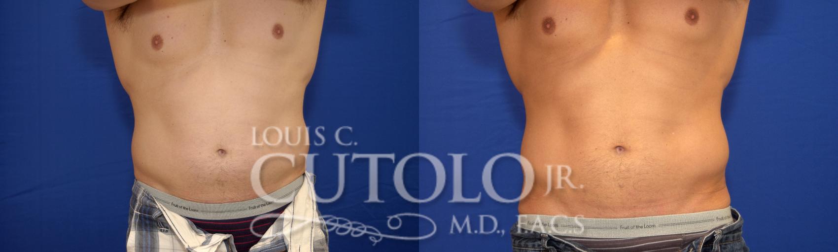 Before & After CoolSculpting® Case 16 View #1 View in Brooklyn, Staten Island, Queens, NY
