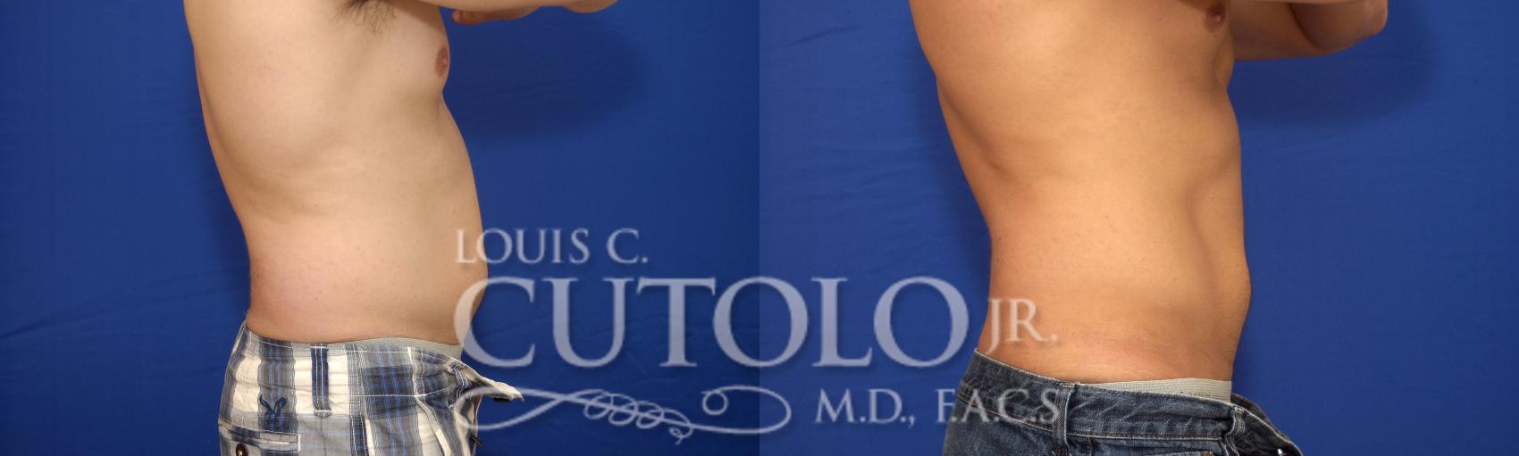Before & After CoolSculpting® Case 16 View #3 View in Brooklyn, Staten Island, Queens, NY