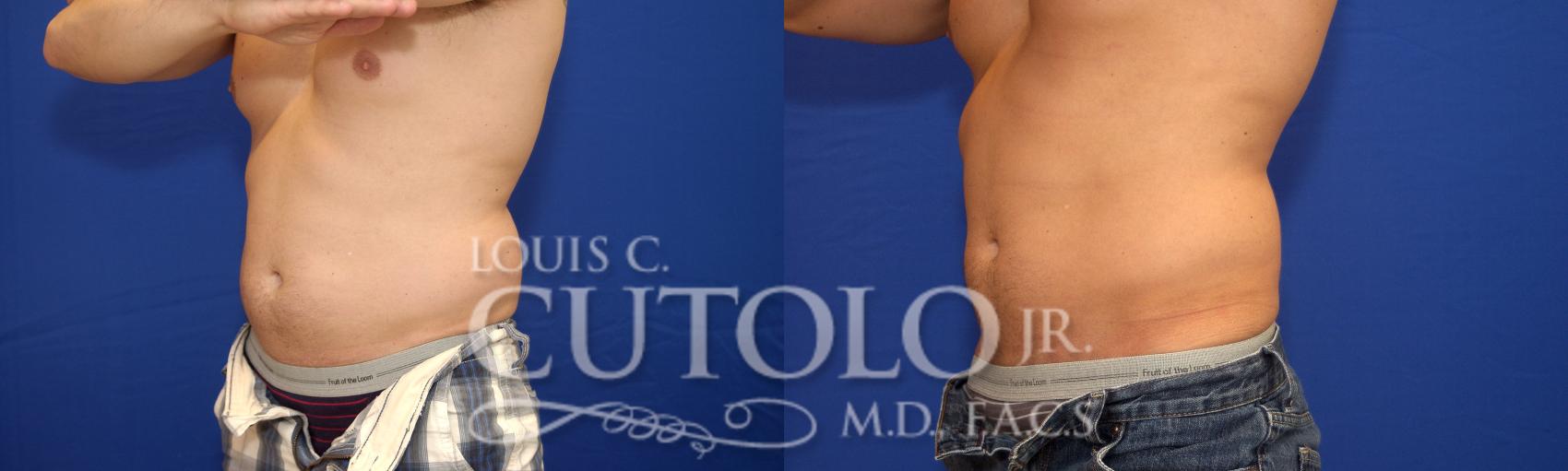 Before & After CoolSculpting® Case 16 View #4 View in Brooklyn, Staten Island, Queens, NY