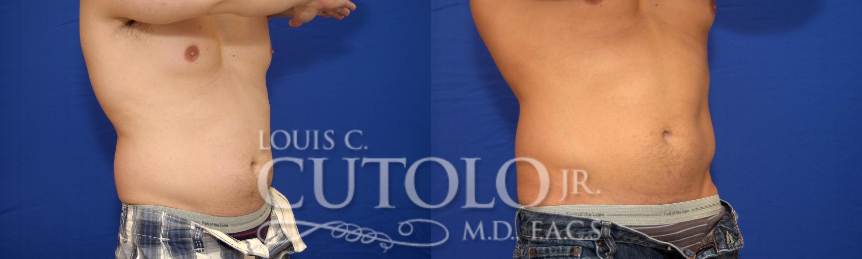 Before & After CoolSculpting® Case 16 View #5 View in Brooklyn, Staten Island, Queens, NY