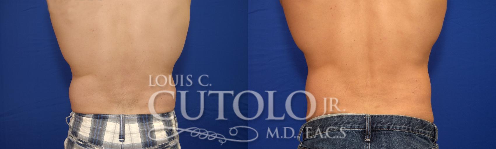 Before & After CoolSculpting® Case 16 View #6 View in Brooklyn, Staten Island, Queens, NY