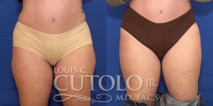 Before & After CoolSculpting® Case 167 View #1 View in Brooklyn, Staten Island, Queens, NY