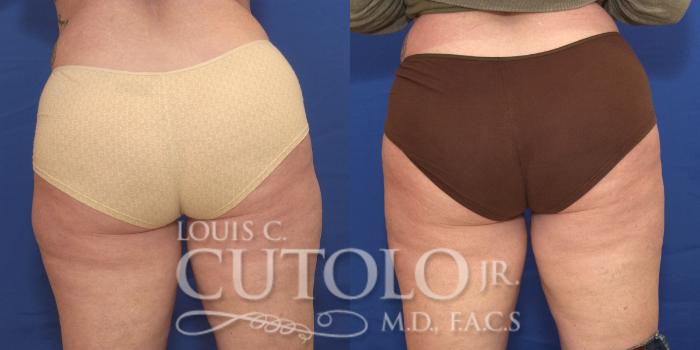 Before & After CoolSculpting® Case 167 View #2 View in Brooklyn, Staten Island, Queens, NY