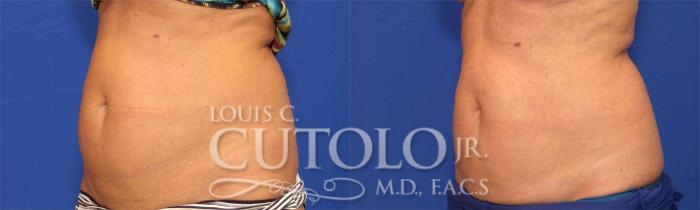 Before & After CoolSculpting® Case 20 View #2 View in Brooklyn, Staten Island, Queens, NY
