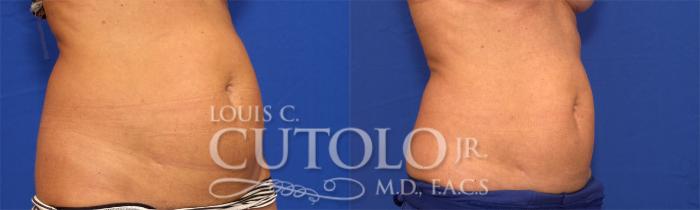 Before & After CoolSculpting® Case 20 View #3 View in Brooklyn, Staten Island, Queens, NY