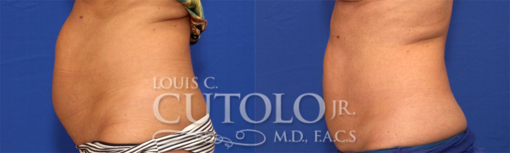 Before & After CoolSculpting® Case 20 View #4 View in Brooklyn, Staten Island, Queens, NY