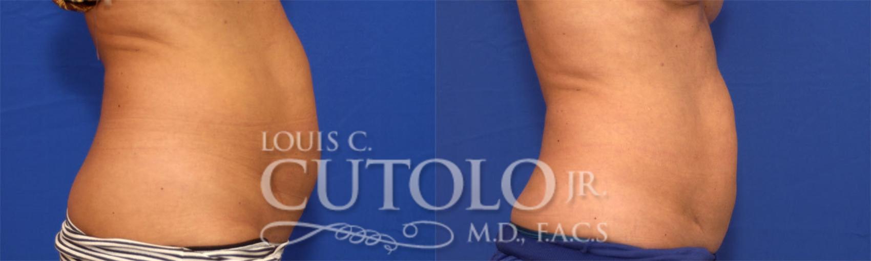 Before & After CoolSculpting® Case 20 View #5 View in Brooklyn, Staten Island, Queens, NY