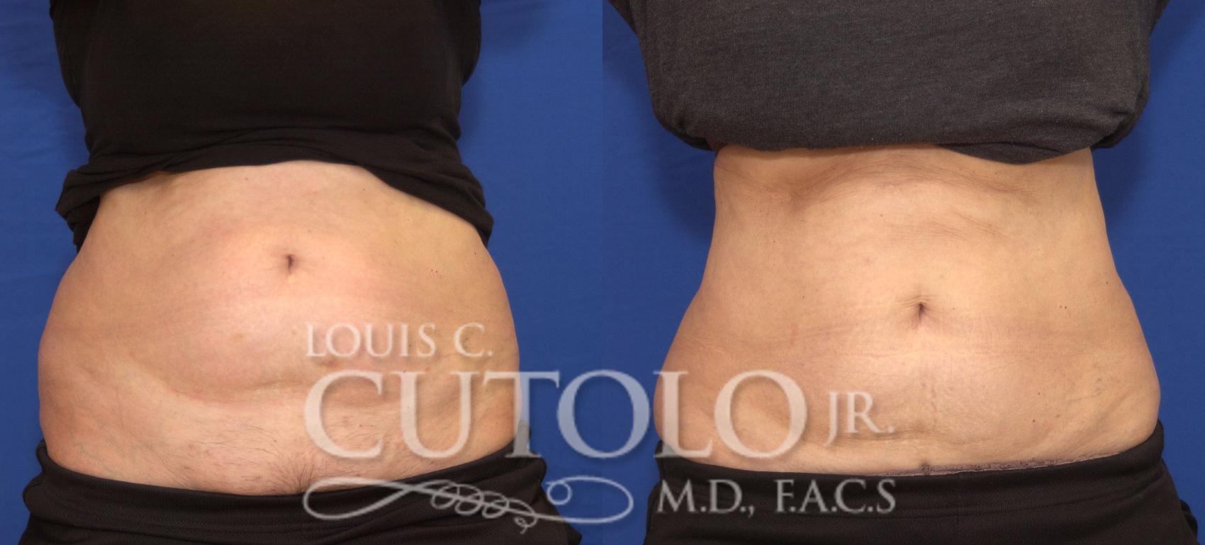 Before & After CoolSculpting® Case 30 View #1 View in Brooklyn, Staten Island, Queens, NY