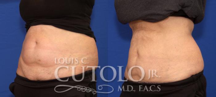 Before & After CoolSculpting® Case 30 View #2 View in Brooklyn, Staten Island, Queens, NY