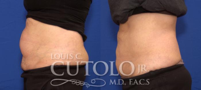 Before & After CoolSculpting® Case 30 View #3 View in Brooklyn, Staten Island, Queens, NY